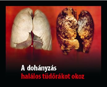 Hungary 2012 Health Effects lung - diseased organ, lung cancer, gross